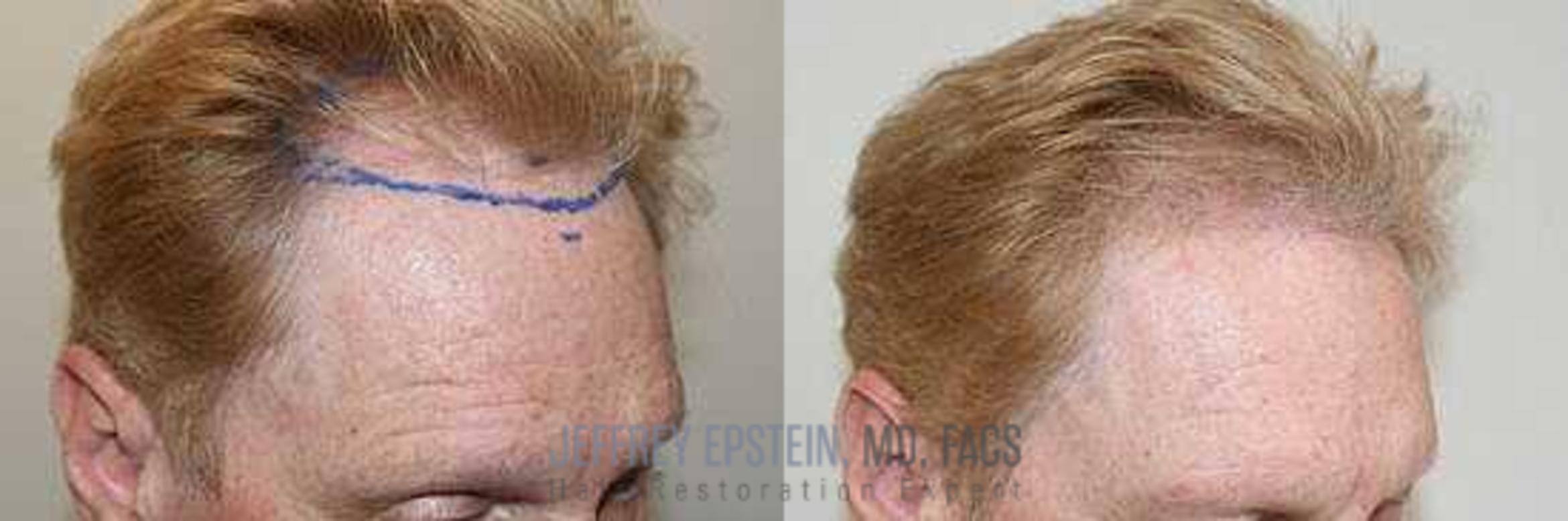 Before & After Hair Transplants For Men Case 37 View 3 View in Miami, FL