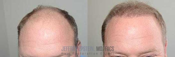 Before & After Hair Transplants For Men Case 39 View 1 View in Miami, FL