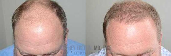 Before & After Hair Transplants For Men Case 39 View 2 View in Miami, FL