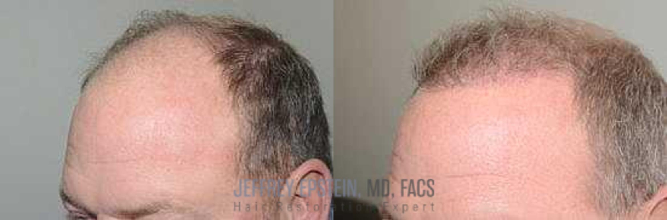 Before & After Hair Transplants For Men Case 39 View 3 View in Miami, FL