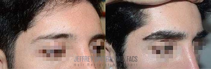 Before & After Hair Transplants For Men Case 40 View 1 View in Miami, FL