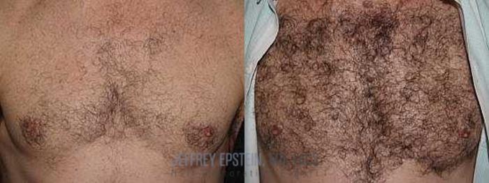 Before & After Hair Transplants For Men Case 408 View 1 View in Miami, FL