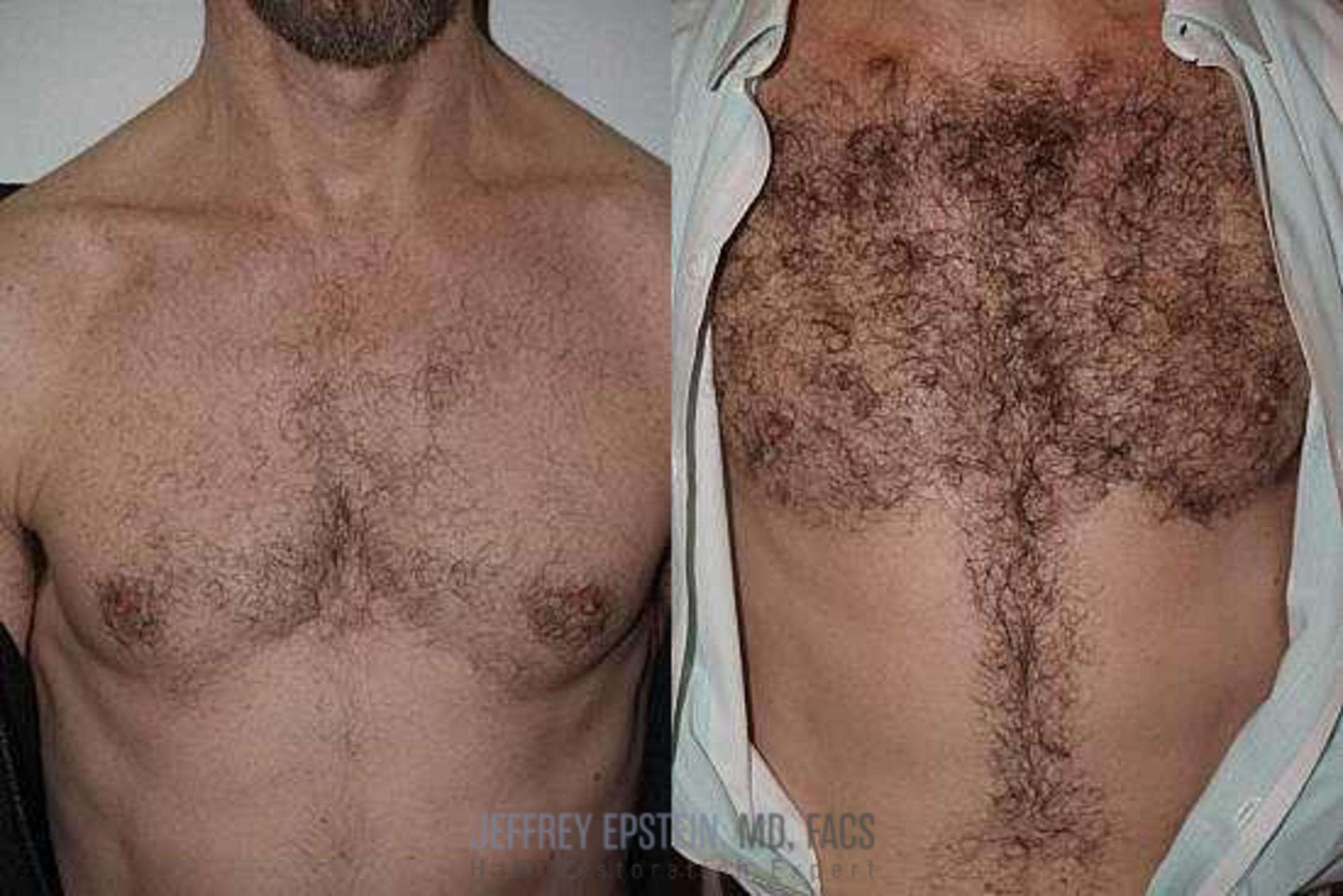 Before & After Hair Transplants For Men Case 408 View 2 View in Miami, FL