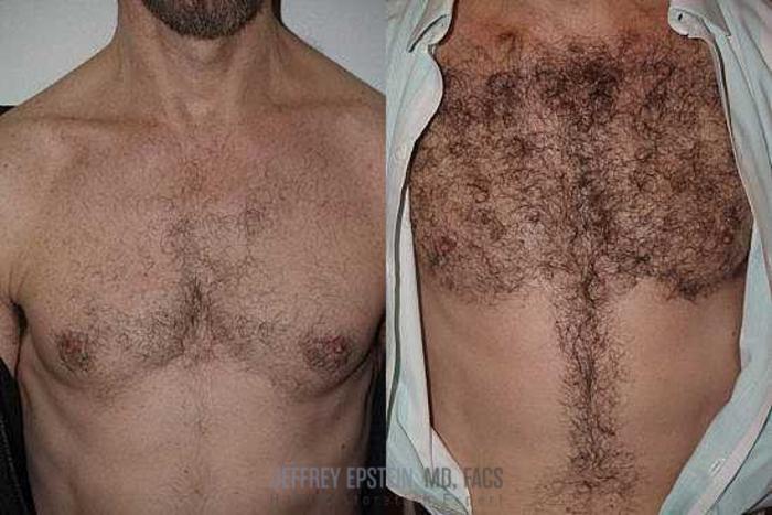 Before & After Hair Transplants For Men Case 408 View 2 View in Miami, FL