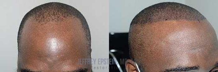 Before & After Hair Transplants For Men Case 41 View 1 View in Miami, FL