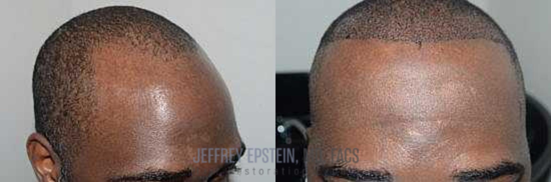 Before & After Hair Transplants For Men Case 41 View 2 View in Miami, FL