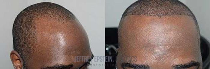 Before & After Hair Transplants For Men Case 41 View 2 View in Miami, FL