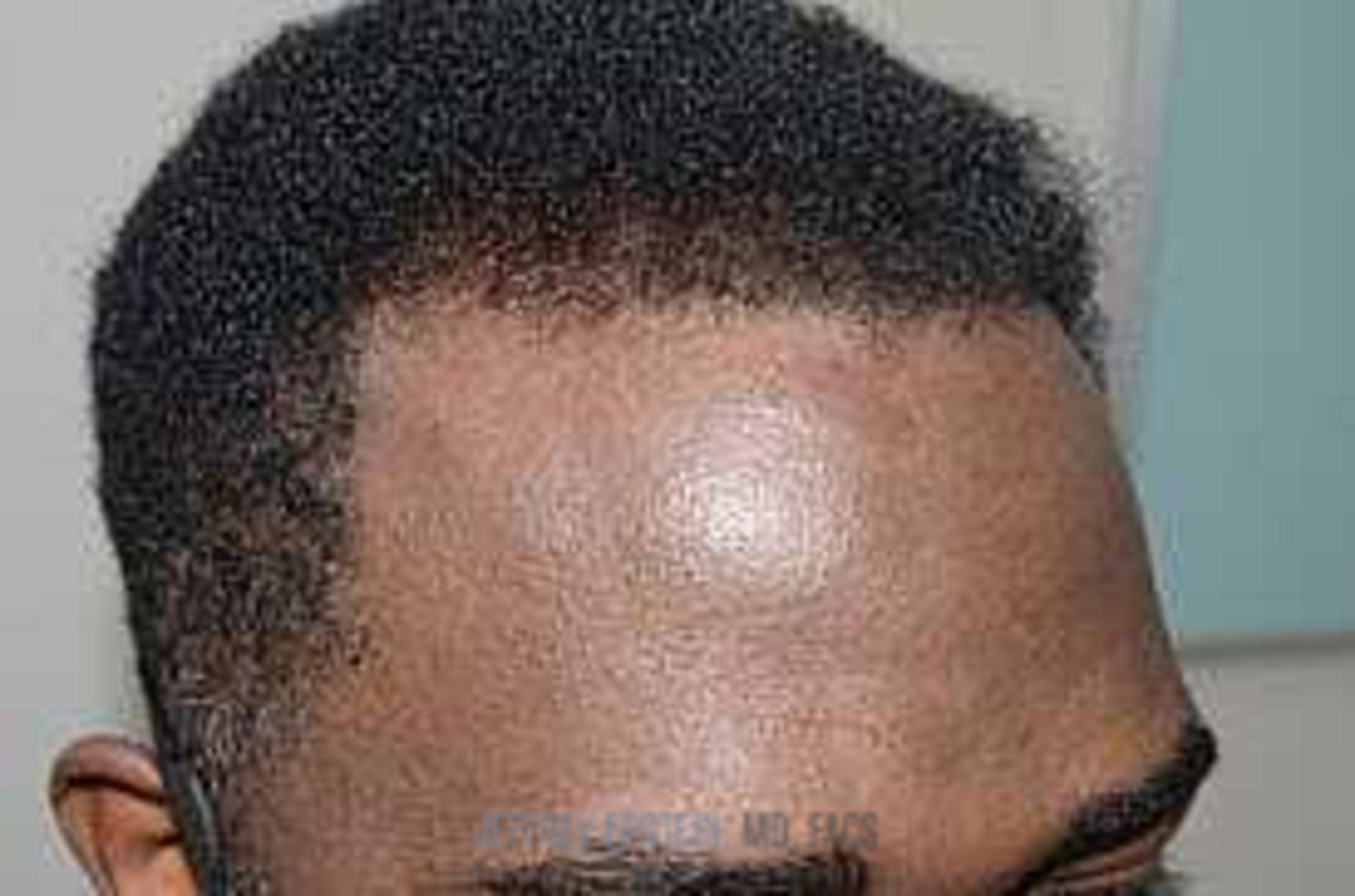 Before & After Hair Transplants For Men Case 41 View 3 View in Miami, FL