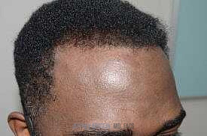 Before & After Hair Transplants For Men Case 41 View 3 View in Miami, FL