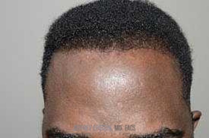 Before & After Hair Transplants For Men Case 41 View 4 View in Miami, FL