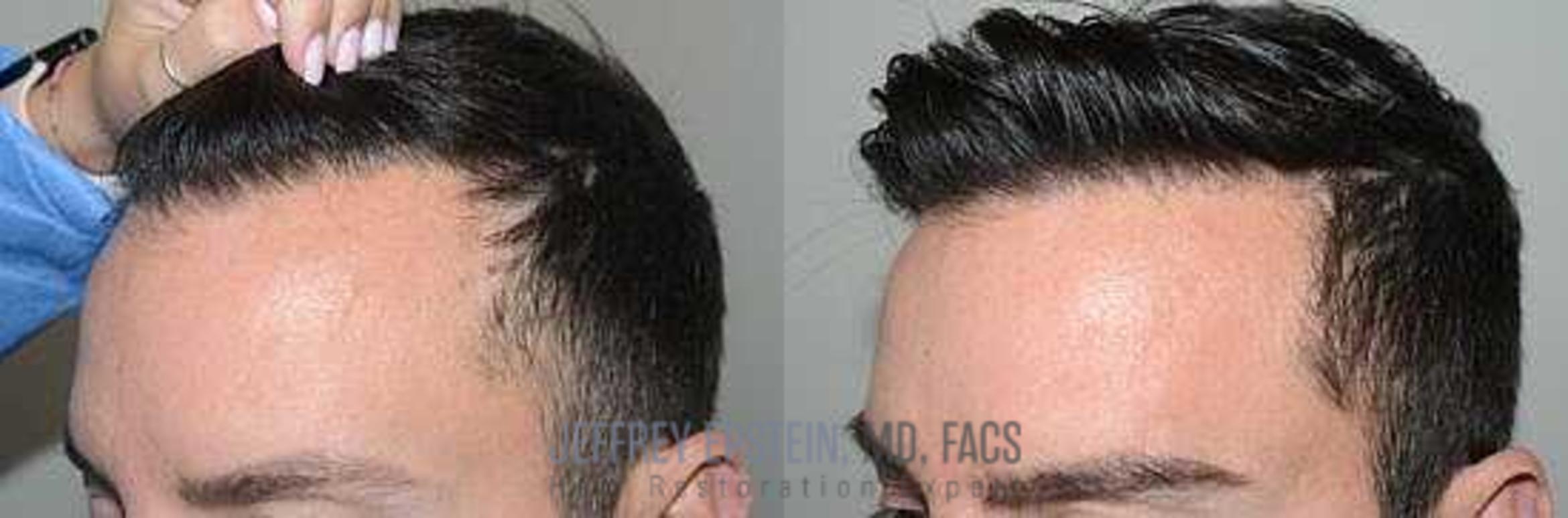 Before & After Hair Transplants For Men Case 42 View 1 View in Miami, FL