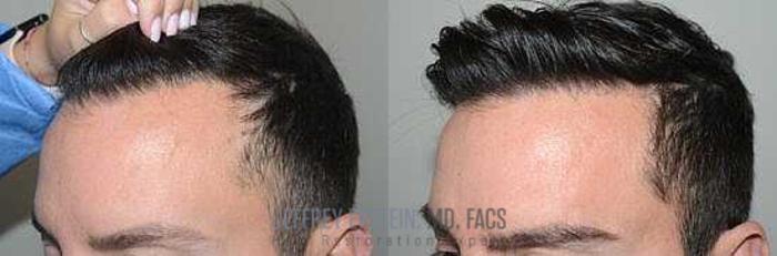 Before & After Hair Transplants For Men Case 42 View 1 View in Miami, FL