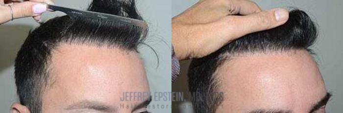 Before & After Hair Transplants For Men Case 42 View 2 View in Miami, FL