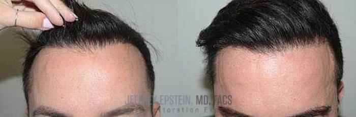 Before & After Hair Transplants For Men Case 42 View 3 View in Miami, FL