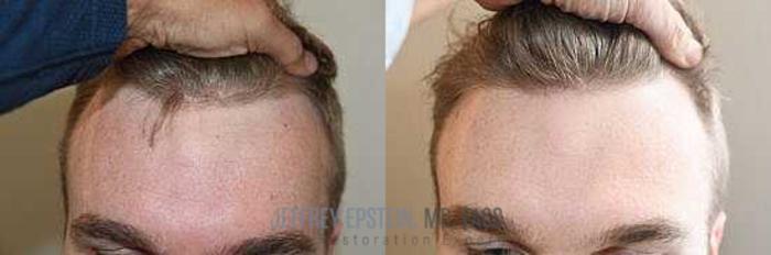 Before & After Hair Transplants For Men Case 43 View 1 View in Miami, FL