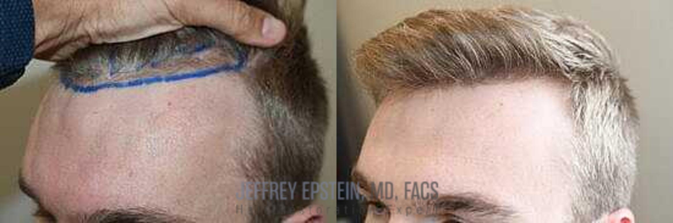 Before & After Hair Transplants For Men Case 43 View 2 View in Miami, FL
