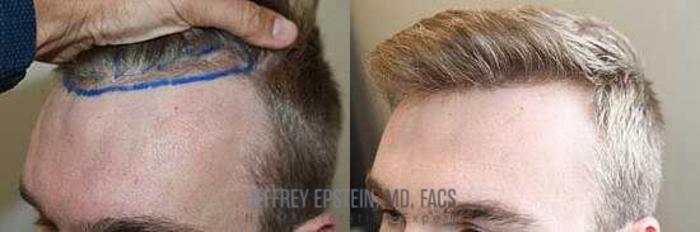 Before & After Hair Transplants For Men Case 43 View 2 View in Miami, FL