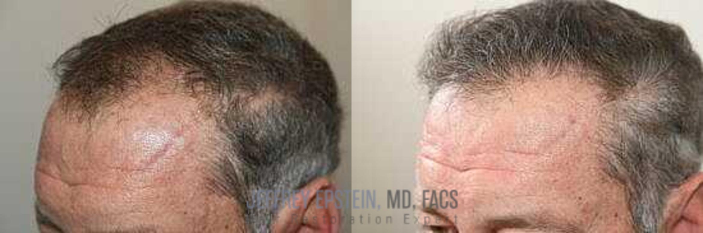 Before & After Hair Transplants For Men Case 45 View 2 View in Miami, FL