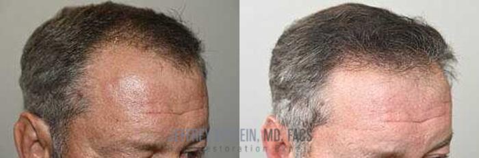 Before & After Hair Transplants For Men Case 45 View 3 View in Miami, FL