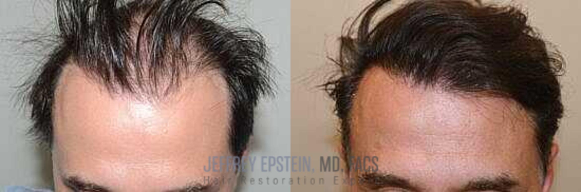 Before & After Hair Transplants For Men Case 46 View 1 View in Miami, FL