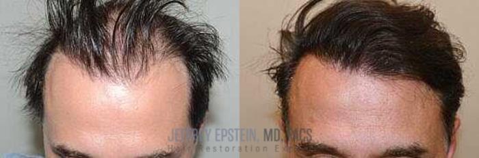 Before & After Hair Transplants For Men Case 46 View 1 View in Miami, FL