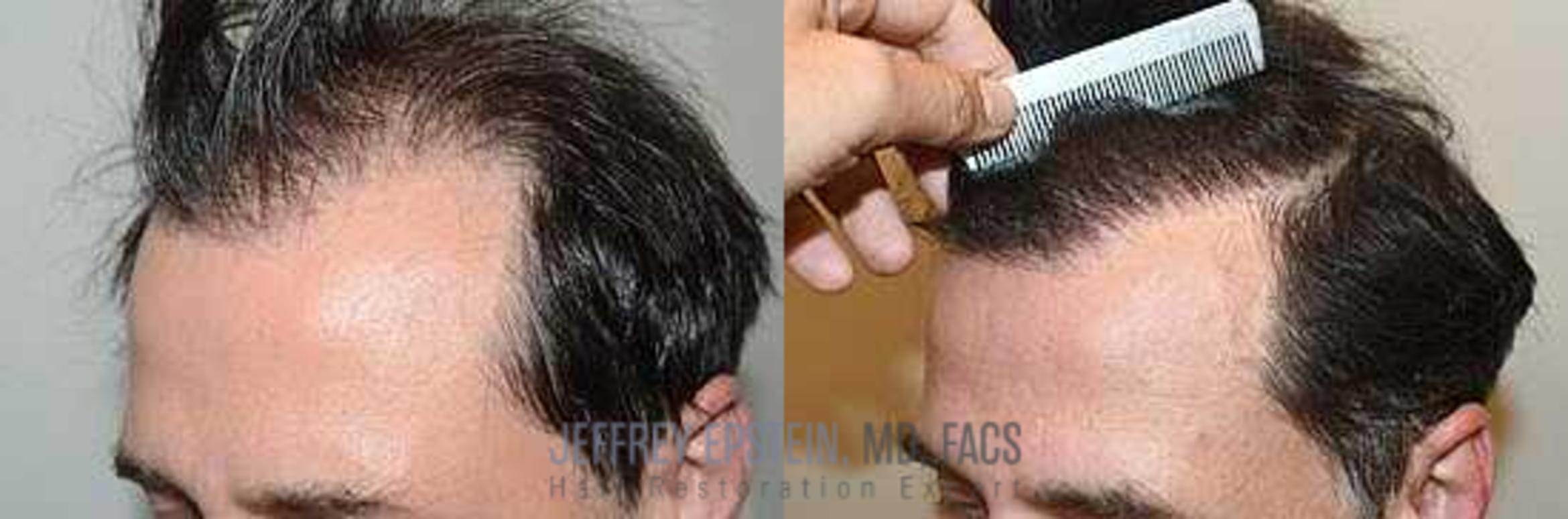 Before & After Hair Transplants For Men Case 46 View 2 View in Miami, FL