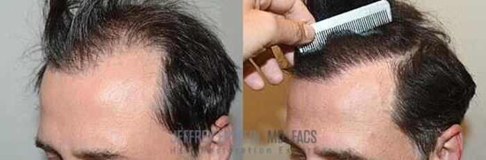Before & After Hair Transplants For Men Case 46 View 2 View in Miami, FL