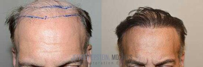 Before & After Hair Transplants For Men Case 47 View 1 View in Miami, FL