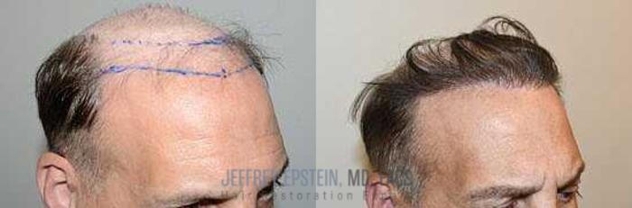 Before & After Hair Transplants For Men Case 47 View 2 View in Miami, FL