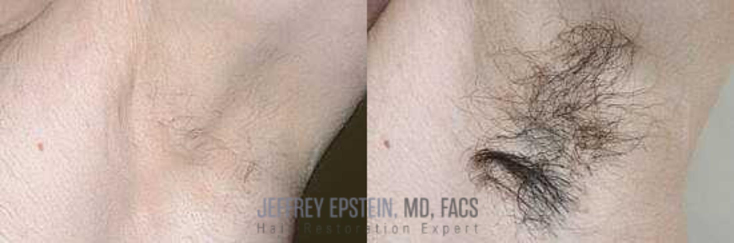 Before & After Hair Transplants For Men Case 48 View 1 View in Miami, FL