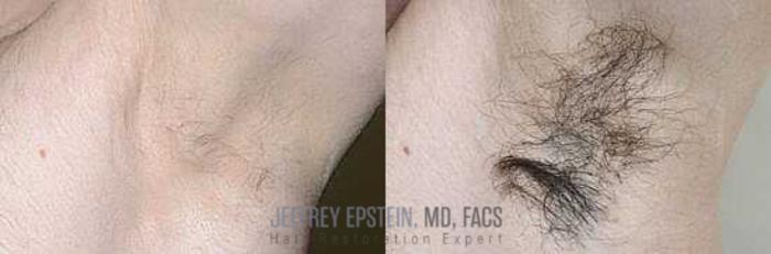 Before & After Hair Transplants For Men Case 48 View 1 View in Miami, FL
