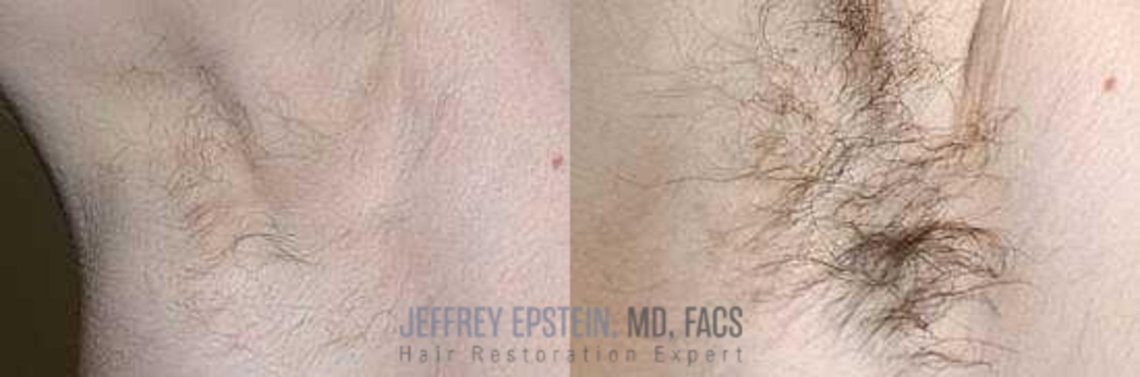 Before & After Hair Transplants For Men Case 48 View 2 View in Miami, FL