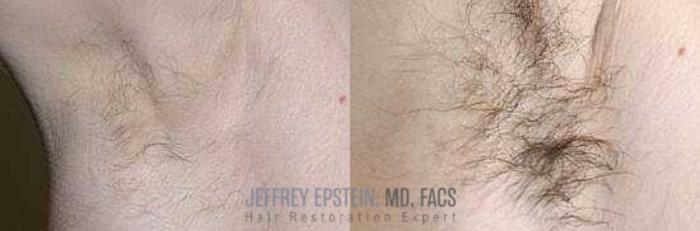 Before & After Hair Transplants For Men Case 48 View 2 View in Miami, FL