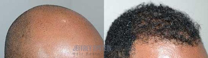 Before & After Hair Transplants For Men Case 49 View 2 View in Miami, FL