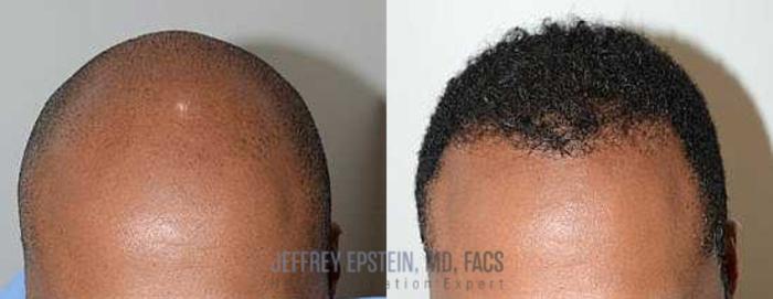 Before & After Hair Transplants For Men Case 49 View 3 View in Miami, FL