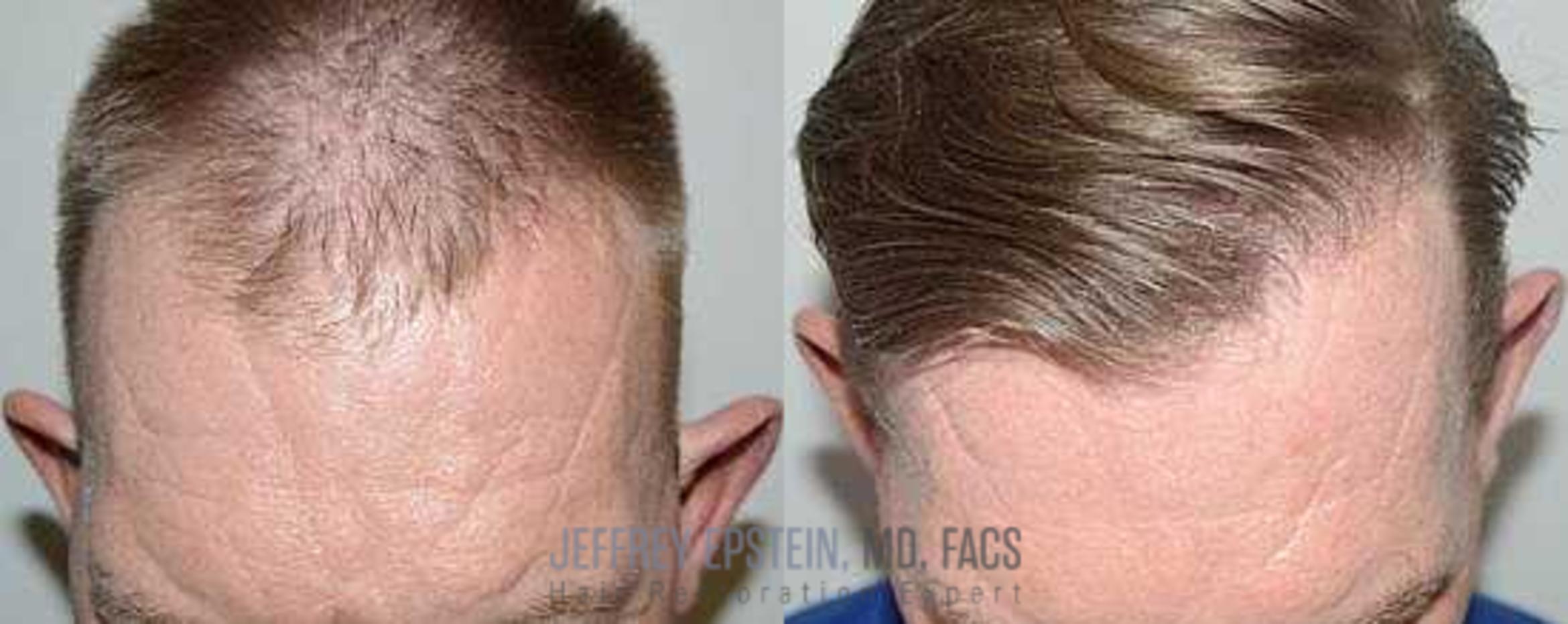 Before & After Hair Transplants For Men Case 50 View 1 View in Miami, FL
