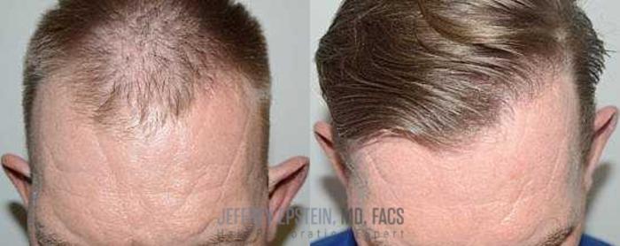 Before & After Hair Transplants For Men Case 50 View 1 View in Miami, FL