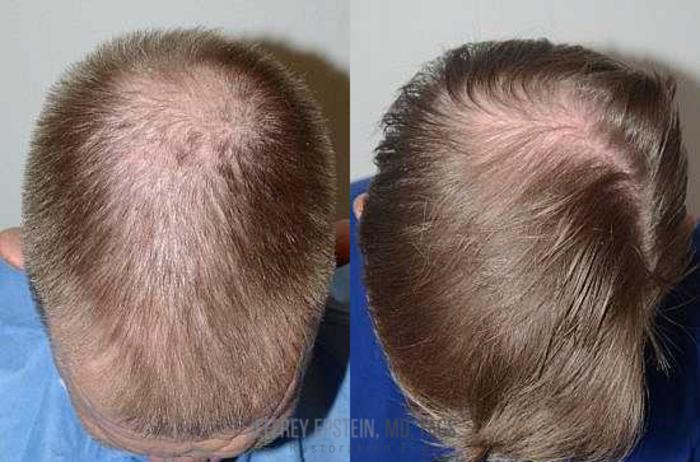 Before & After Hair Transplants For Men Case 50 View 2 View in Miami, FL
