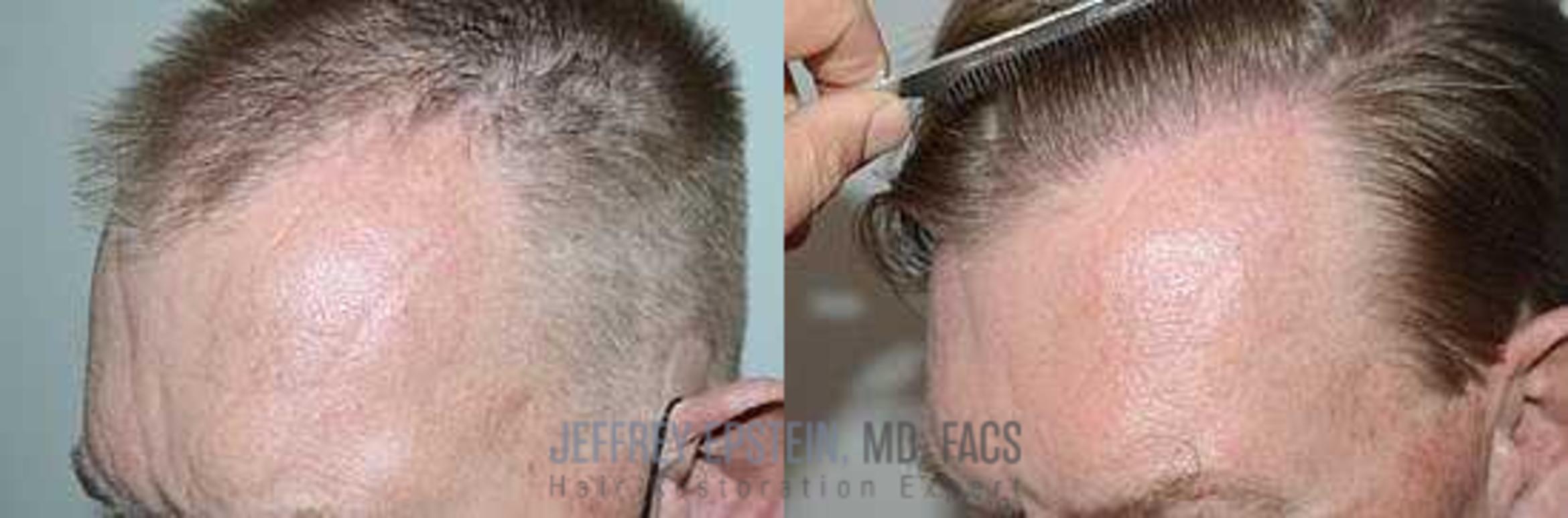 Before & After Hair Transplants For Men Case 50 View 3 View in Miami, FL