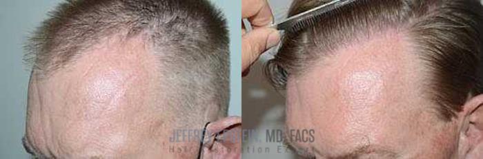 Before & After Hair Transplants For Men Case 50 View 3 View in Miami, FL