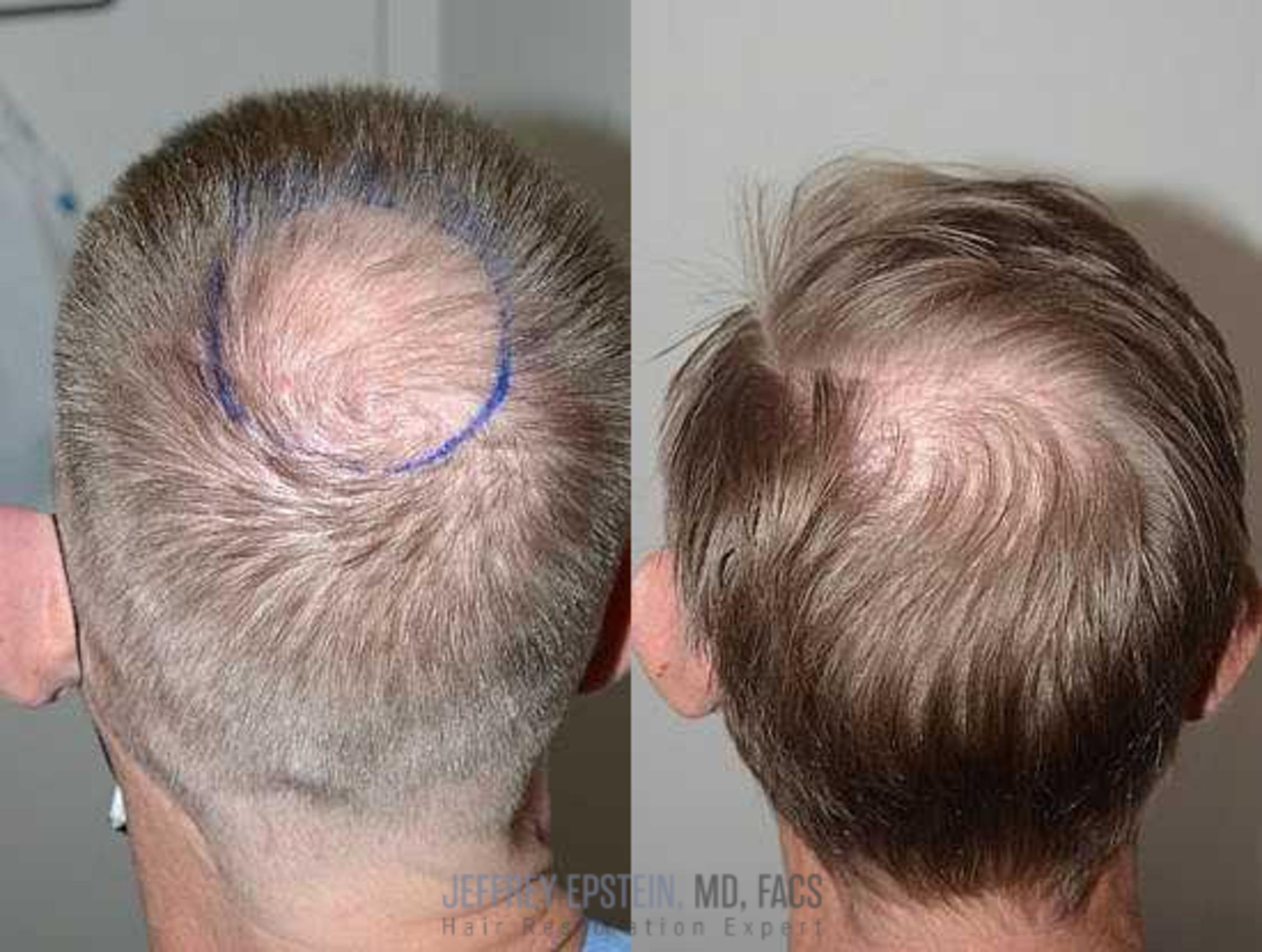 Before & After Hair Transplants For Men Case 50 View 4 View in Miami, FL