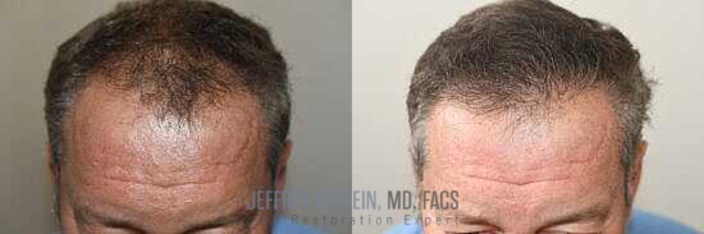 Before & After Hair Transplants For Men Case 51 View 1 View in Miami, FL