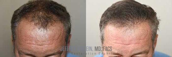 Before & After Hair Transplants For Men Case 51 View 1 View in Miami, FL