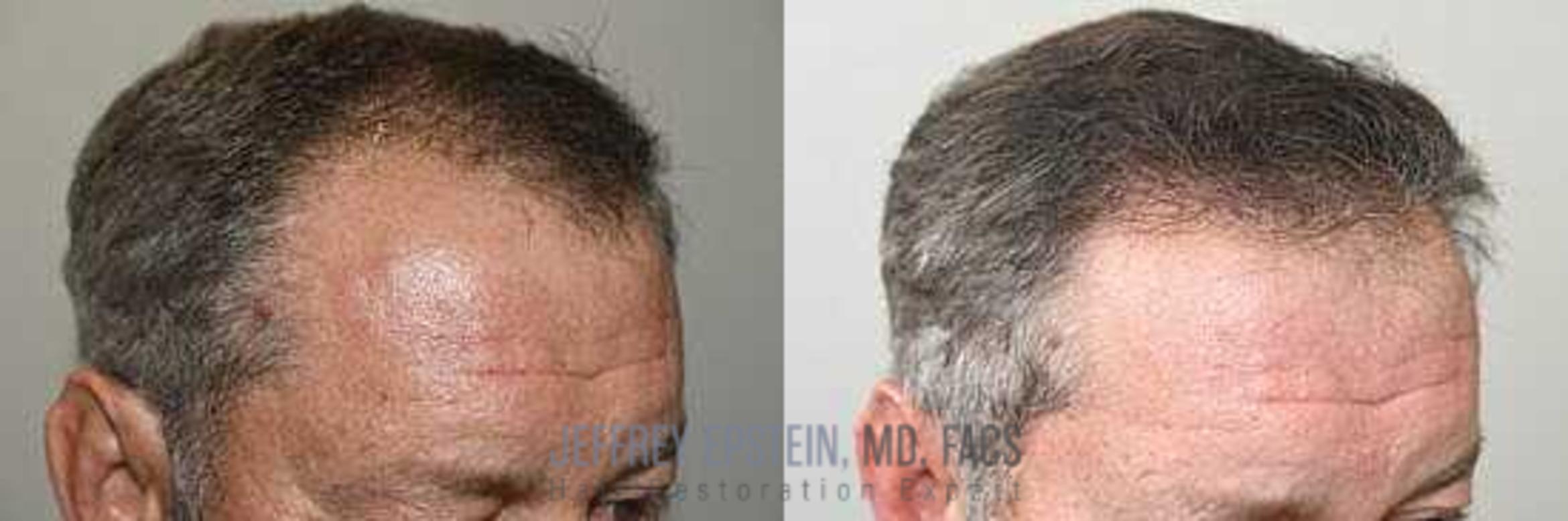 Before & After Hair Transplants For Men Case 51 View 2 View in Miami, FL