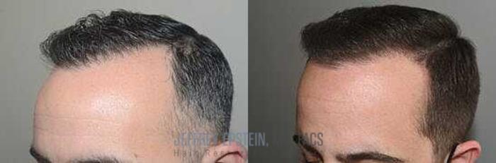 Before & After Hair Transplants For Men Case 52 View 1 View in Miami, FL