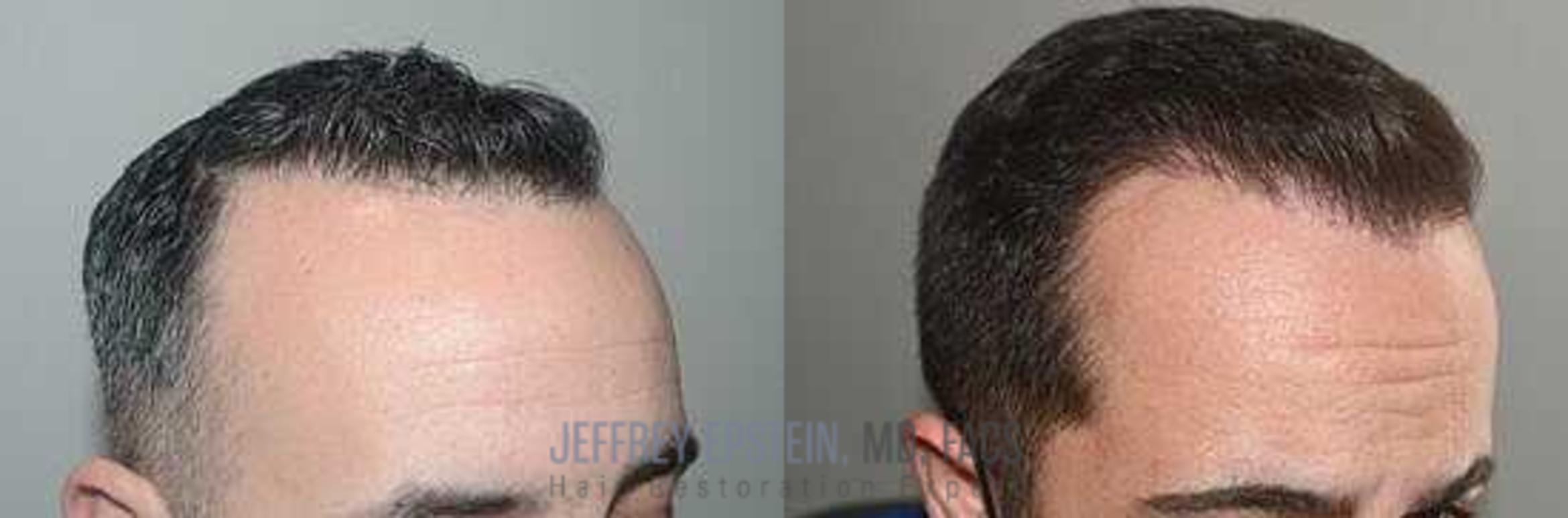 Before & After Hair Transplants For Men Case 52 View 2 View in Miami, FL