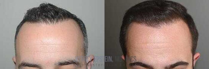 Before & After Hair Transplants For Men Case 52 View 3 View in Miami, FL
