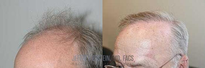 Before & After Hair Transplants For Men Case 53 View 1 View in Miami, FL