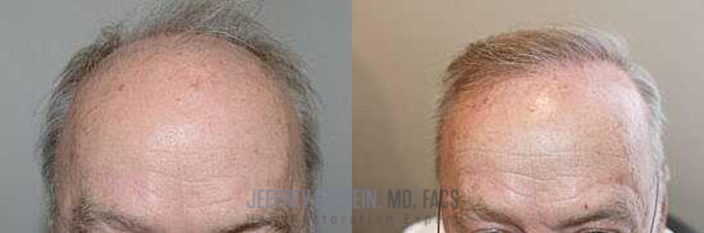 Before & After Hair Transplants For Men Case 53 View 2 View in Miami, FL
