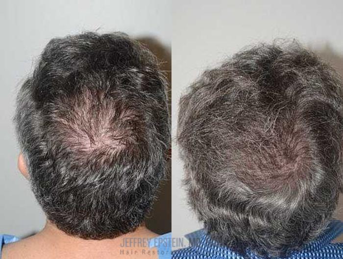 Before & After Hair Transplants For Men Case 54 View 1 View in Miami, FL